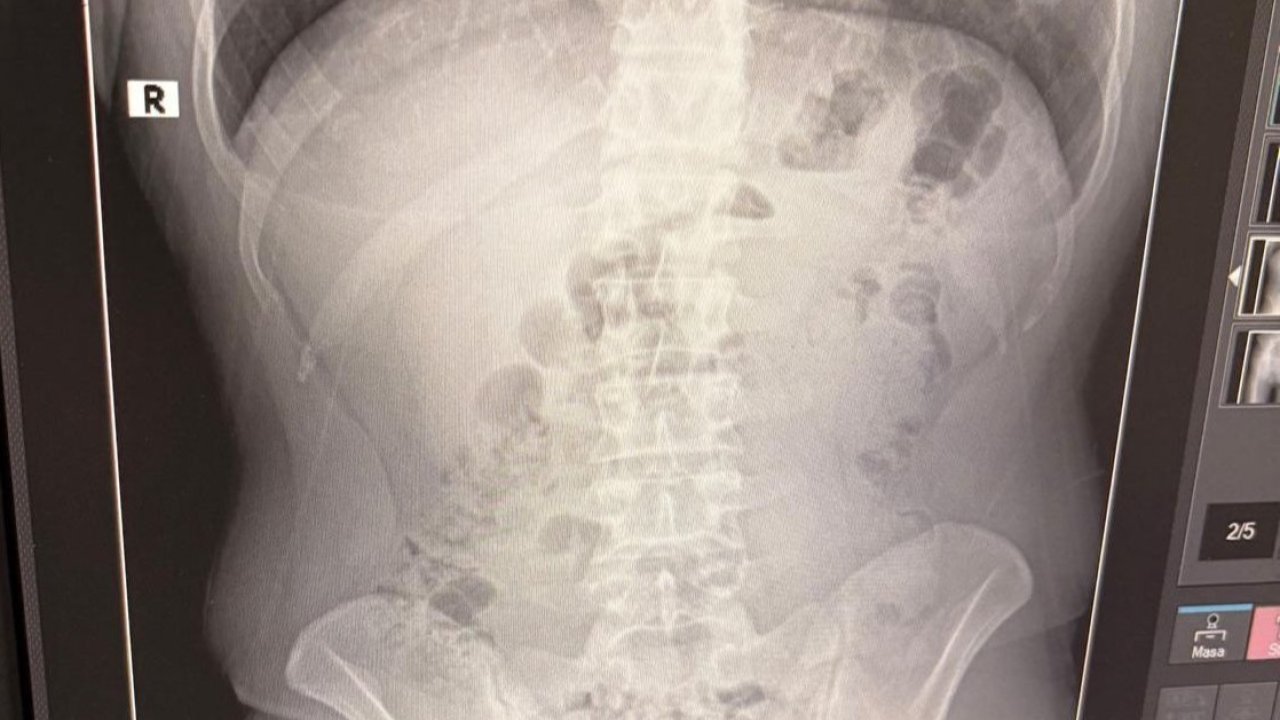 Uşak’ta Midelerinden Uyuşturucu Çıktı: İranlı 3 Kişi Tutuklandı