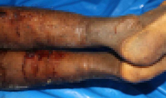 İsrail'in iade ettiği cenazelerde işkence izleri görüldü