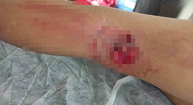 Okula giderken sokak köpeğinin saldırısına uğradı