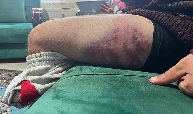 Vicdanları yaralayan olay: Otizmli şahıs odunluğa baktı diye odunla darbedildi