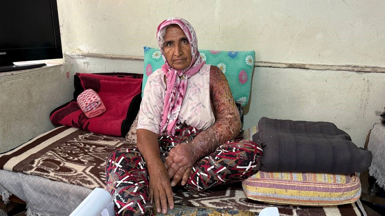 Kolu Şişti, Vücuduna Kadar Yara Oldu: 4 Çocuk Annesinin Zorlu Yaşamı