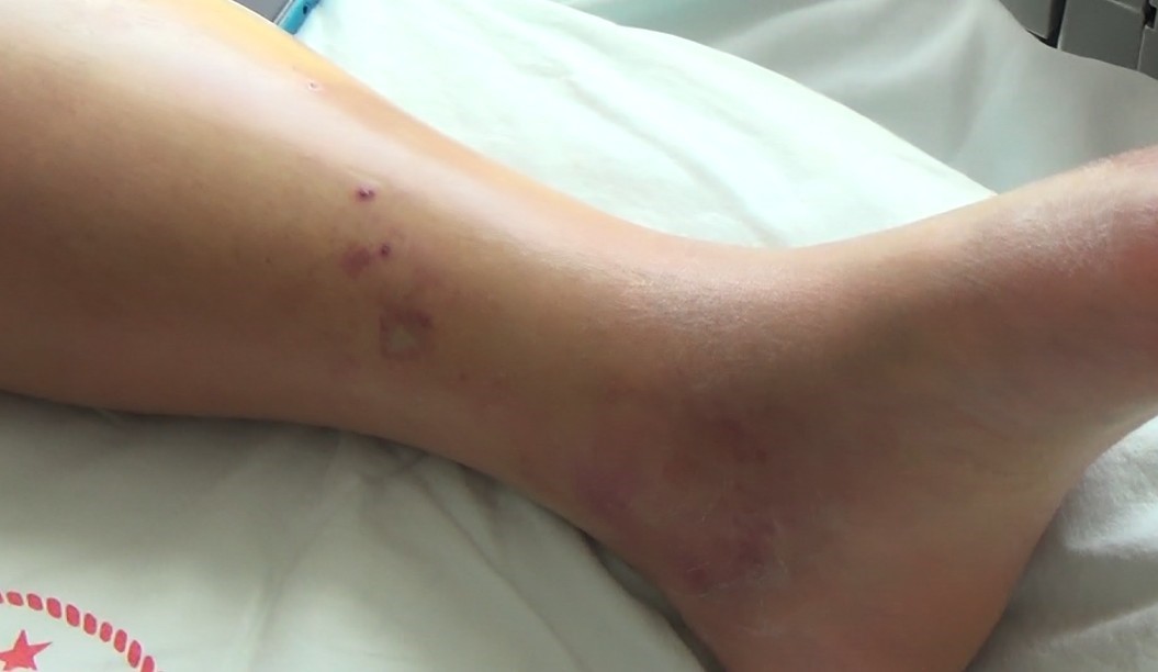 Tunceli’de Koca Engerek Yılanının Isırdığı Kadın, Tedavi Altına Alındı